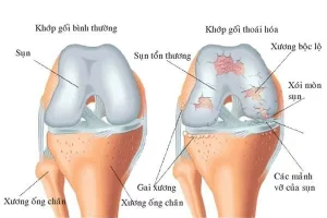 Đau khớp do sụn khớp bị mòn: "Thủ phạm" gây khó chịu và cách đối phó