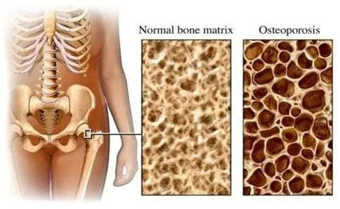 Làm thế nào để bảo vệ xương và khớp khi bị loãng xương?
