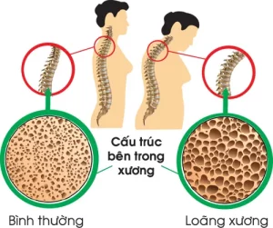 Bệnh loãng xương ảnh hưởng đến khớp thế nào? Mối liên hệ bạn cần biết