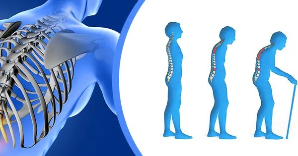Loãng xương là gì và nó khác gì với các bệnh về khớp?