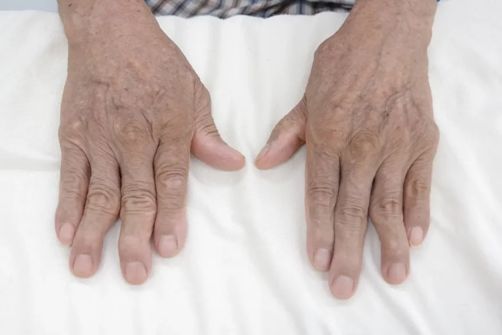 "Chìa khóa" để sống tốt với bệnh viêm khớp dạng thấp