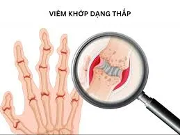 Bệnh viêm khớp dạng thấp là gì? Nguyên nhân, triệu chứng và cách điều trị hiệu quả