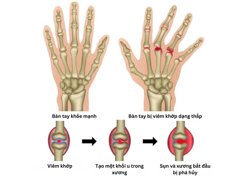 Bệnh viêm khớp dạng thấp (Rheumatoid Arthritis) là gì? "Kẻ thù" thầm lặng của khớp