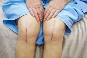 Biến chứng sau thay khớp gối: Những điều cần biết để phòng ngừa và đối phó