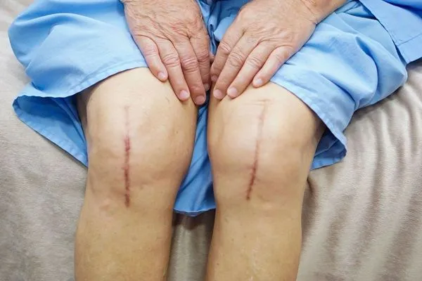 Biến chứng sau thay khớp gối: Những điều cần biết để phòng ngừa và đối phó