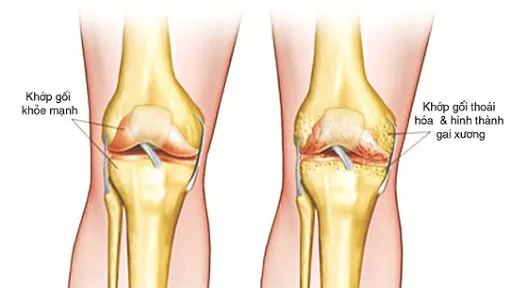 Tiêu chuẩn chẩn đoán thoái hóa khớp: "Kết hợp" các yếu tố