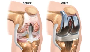 Chi phí thay khớp gối hiện nay là bao nhiêu? "Bóc tách" các yếu tố ảnh hưởng