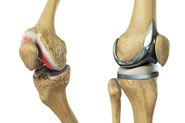 "Túi tiền" cần chuẩn bị: Chi phí thay khớp gối dao động như thế nào?