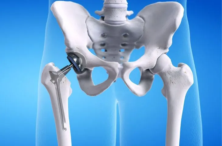 Thay khớp háng có đáng sợ như bạn nghĩ?