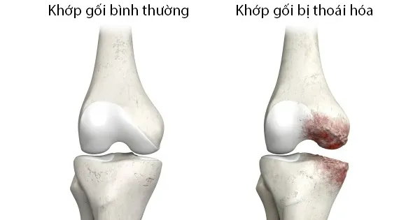 "Cứu tinh" cho khớp thoái hóa: Các phương pháp điều trị không xâm lấn
