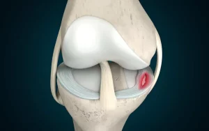 Điều trị tổn thương sụn chêm: "Cẩm nang" giúp bạn đưa ra quyết định tốt nhất