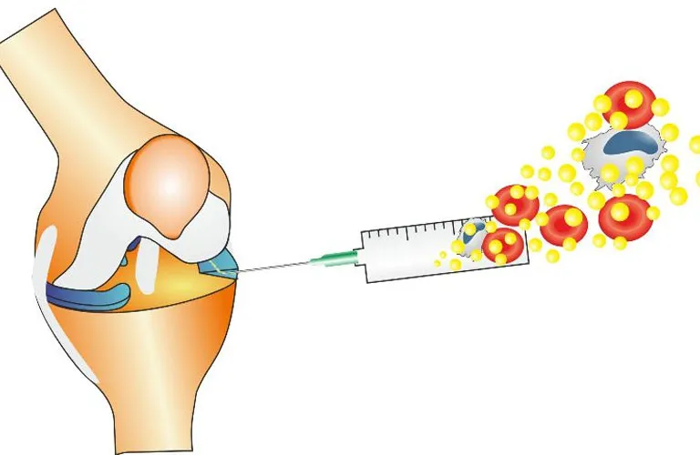 Sụn chêm là gì và tại sao nó lại dễ bị "hỏng"?