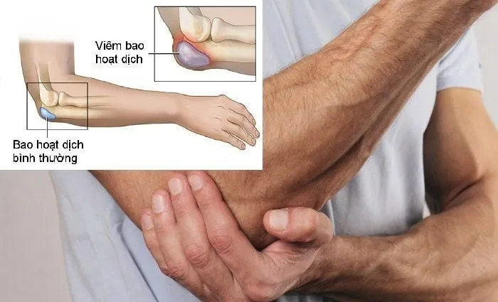 Viêm bao hoạt dịch khớp là gì và điều trị có khó không?