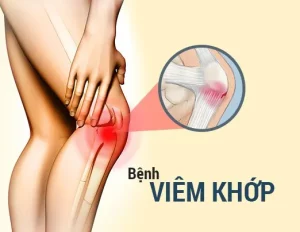 Điều trị viêm khớp gối hiệu quả: Các phương pháp và lời khuyên từ chuyên gia