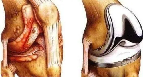 Những lợi ích tuyệt vời của việc thay khớp gối đúng thời điểm