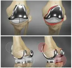Dấu hiệu cho thấy khớp gối đang "kêu cứu": Đừng bỏ qua những "tín hiệu" quan trọng