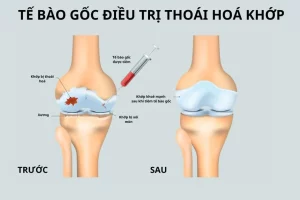 Liệu pháp tế bào gốc điều trị khớp: Bước đột phá mới cho hy vọng phục hồi