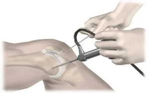 Phẫu thuật nội soi khớp gối là gì? Những điều bạn cần biết