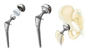 Phẫu thuật thay khớp háng bán phần: Giải pháp tối ưu trong một số trường hợp
