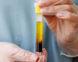 Phương pháp tiêm huyết tương giàu tiểu cầu PRP: "Liều thuốc" tự nhiên cho phục hồi và trẻ hóa