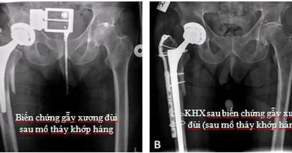Phẫu thuật thay khớp: Lợi ích vượt trội đi kèm rủi ro tiềm ẩn