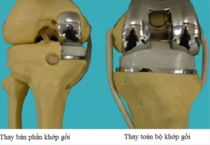 Thay khớp gối toàn phần là gì? Giải đáp thắc mắc từ A đến Z