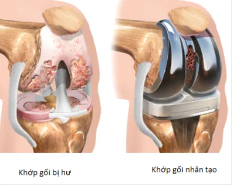 Thay khớp gối toàn phần là gì?