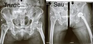 Phục hồi chức năng sau thay khớp háng do gãy cổ xương đùi: Bước quan trọng để trở lại cuộc sống