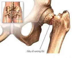 Quá trình phẫu thuật thay khớp gối ở người béo phì có gì khác biệt?
