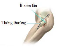 Phẫu thuật thay khớp háng đường mổ nhỏ ít xâm lấn: Bước tiến cho sự phục hồi nhanh chóng