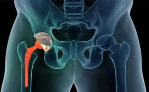 Thay khớp háng hai bên cùng lúc có nên không? Cân nhắc lợi ích và rủi ro
