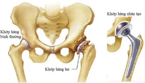 Thay khớp háng là gì? Khi nào cần thay và quy trình thực hiện như thế nào?