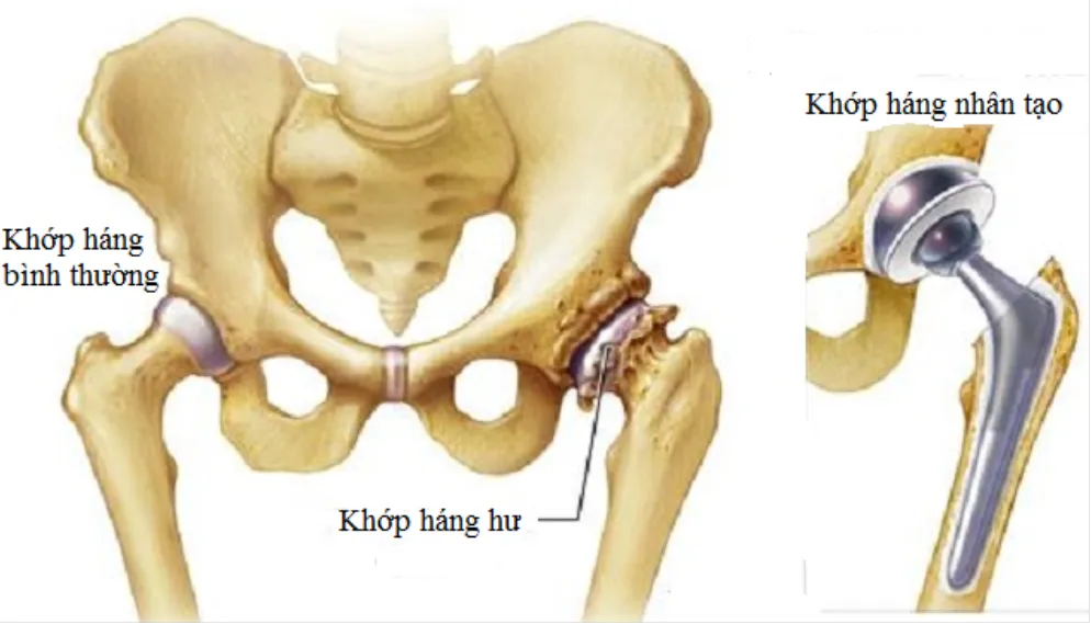 Thay khớp háng là gì? Khi nào cần thay và quy trình thực hiện như thế nào?