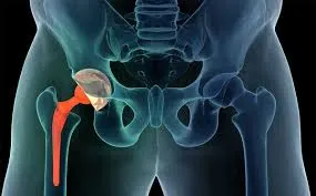 Thay khớp háng nhân tạo có nguy hiểm không? Giải đáp từ chuyên gia