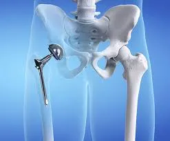 Lời khuyên khi lựa chọn bệnh viện thay khớp háng