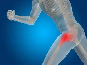 Thay khớp háng ở đâu tốt tại Việt Nam? Top các bệnh viện uy tín