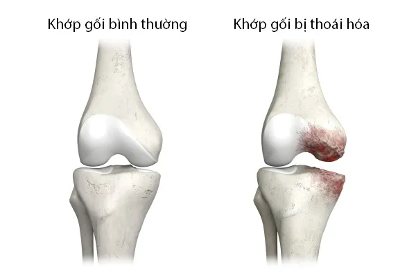 "Bản đồ" các phương pháp giúp bạn "sống chung" hiệu quả với thoái hóa khớp