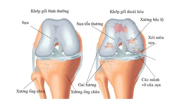 Thoái hóa sụn khớp là gì? Nguyên nhân, dấu hiệu và cách bảo vệ hiệu quả