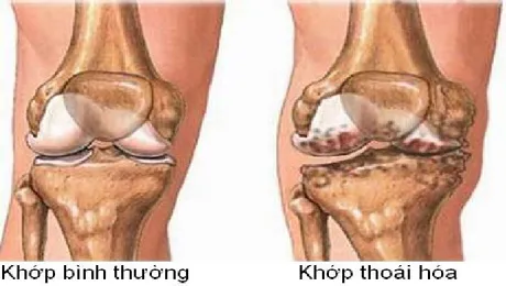 "Điểm danh" các nguyên nhân chính gây thoái hóa sụn khớp