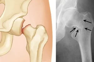 Thời gian nằm viện sau khi thay khớp háng là bao nhiêu ngày? Giải đáp chi tiết