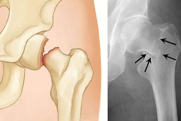 Thời gian nằm viện sau khi thay khớp háng là bao nhiêu ngày? Giải đáp chi tiết